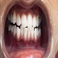 Teeth Whitening in Mumbai